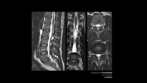 SmartSpeed – Spine