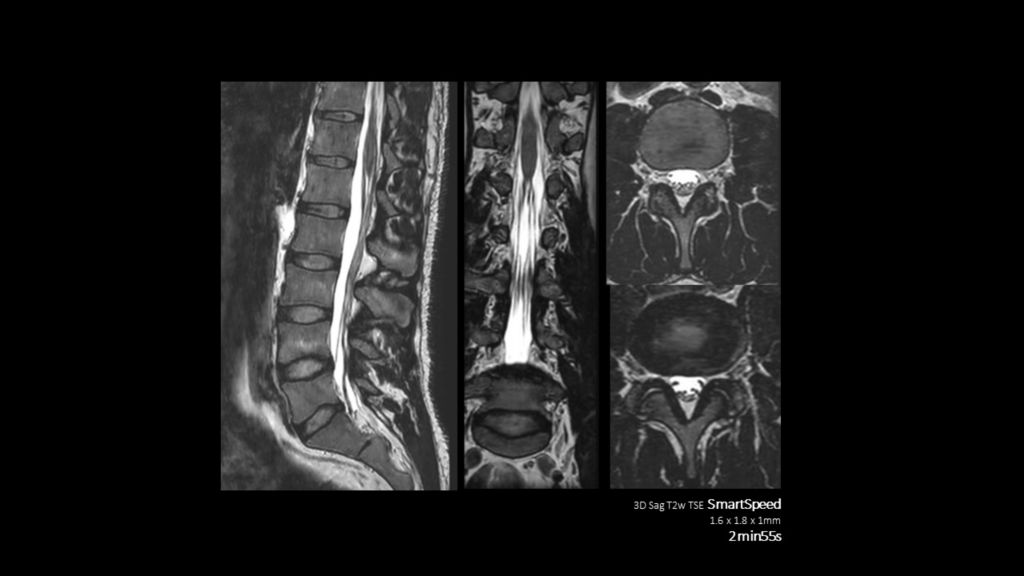 SmartSpeed -Spine