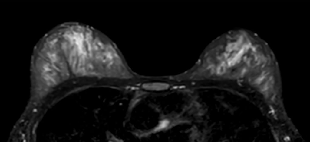 T2w SPAIR - Breast