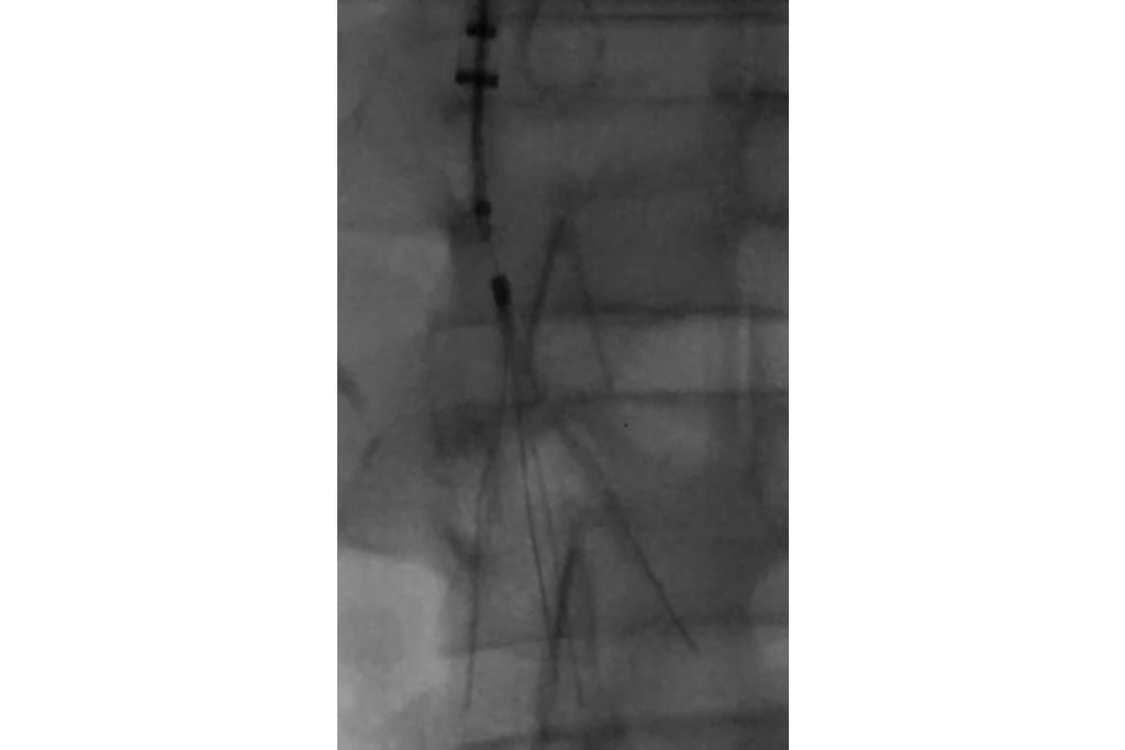 Laser mechanism of action does not damage the IVC filter.⁸