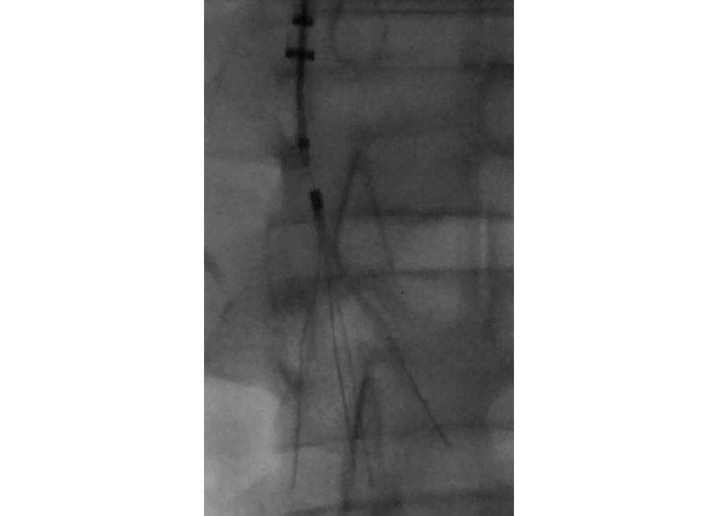 Laser mechanism of action does not damage the IVC filter.⁸