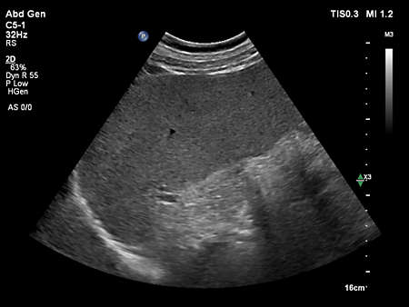 C5-1 Abdomen Spleen Imaging