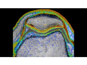 Smart Quant - MSK MR Clinical Applications