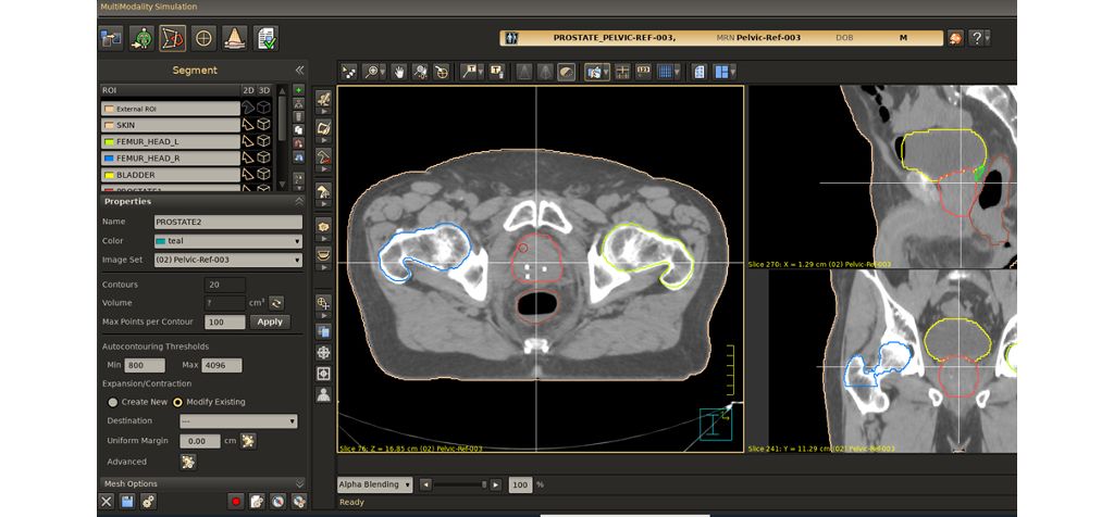 Users can mix and match segmentation tools, using different algorithms for different organs on the same dataset.