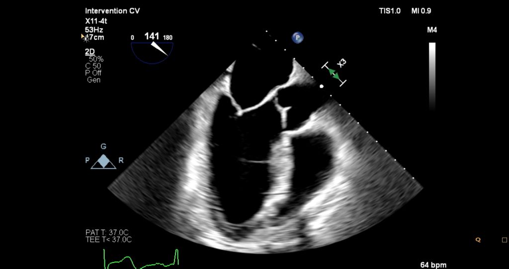 X11-4t mini 3D TEE Left Ventricle