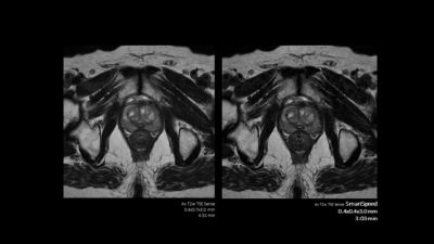 Vergelijking van prostaat-MRI-scans met en zonder Philips SmartSpeed-technologie