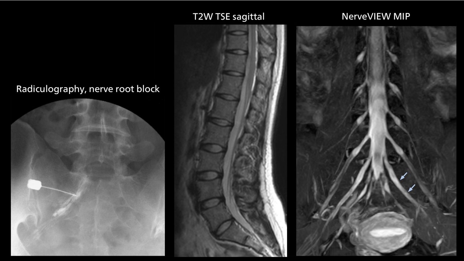 MR neurography of Left sacroiliac arthritis
