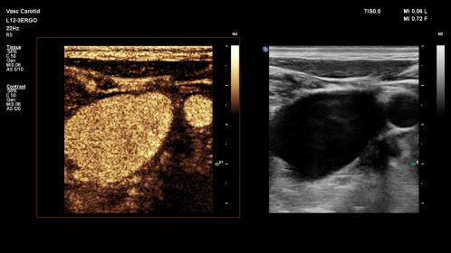L12-3 paired with CEUS Auto Scan, scanning on the Vascular Carotid Preset