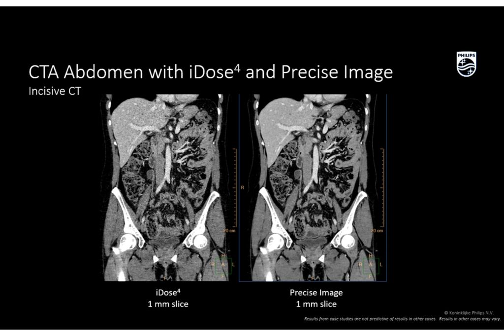 Incisive CT Abdomen with iDose4 and precise image