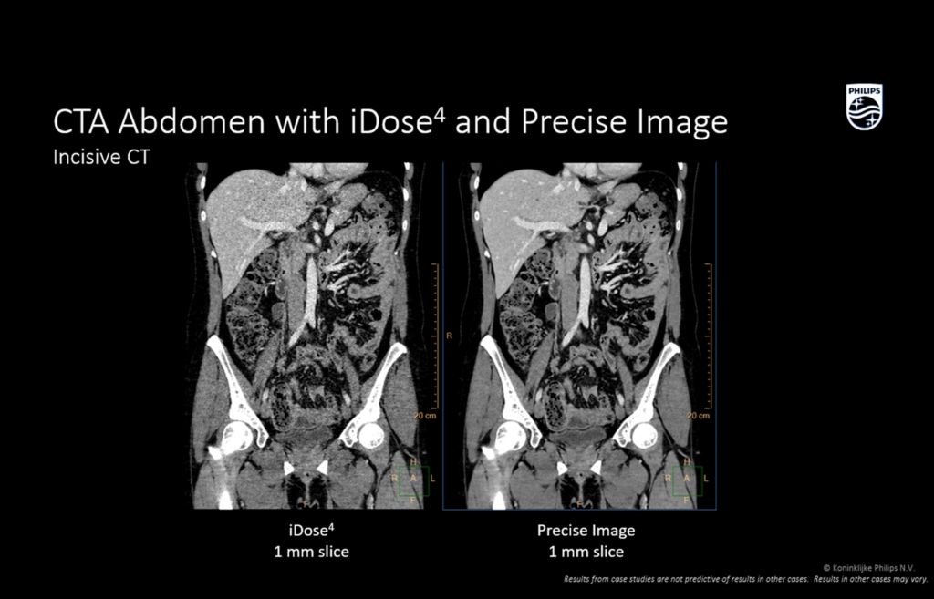 Incisive CT Abdomen with iDose4 and precise image