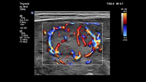 Flow Viewer applied to thyroid nodule with the eL18-4 transducer
