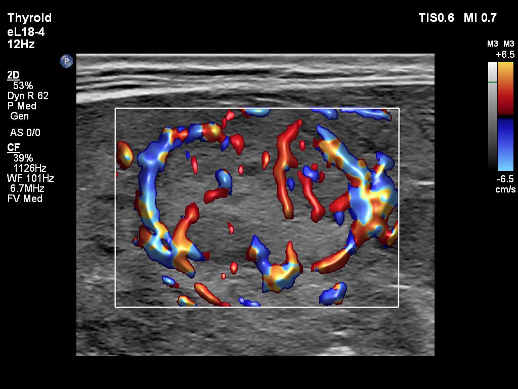 Flow Viewer applied to thyroid nodule with the eL18-4 transducer