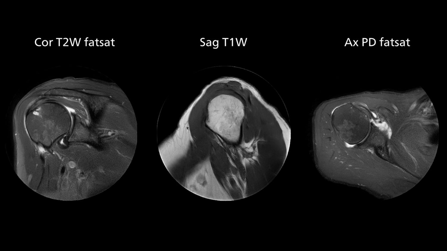 MRI of shoulder with MultiVane motion reduction