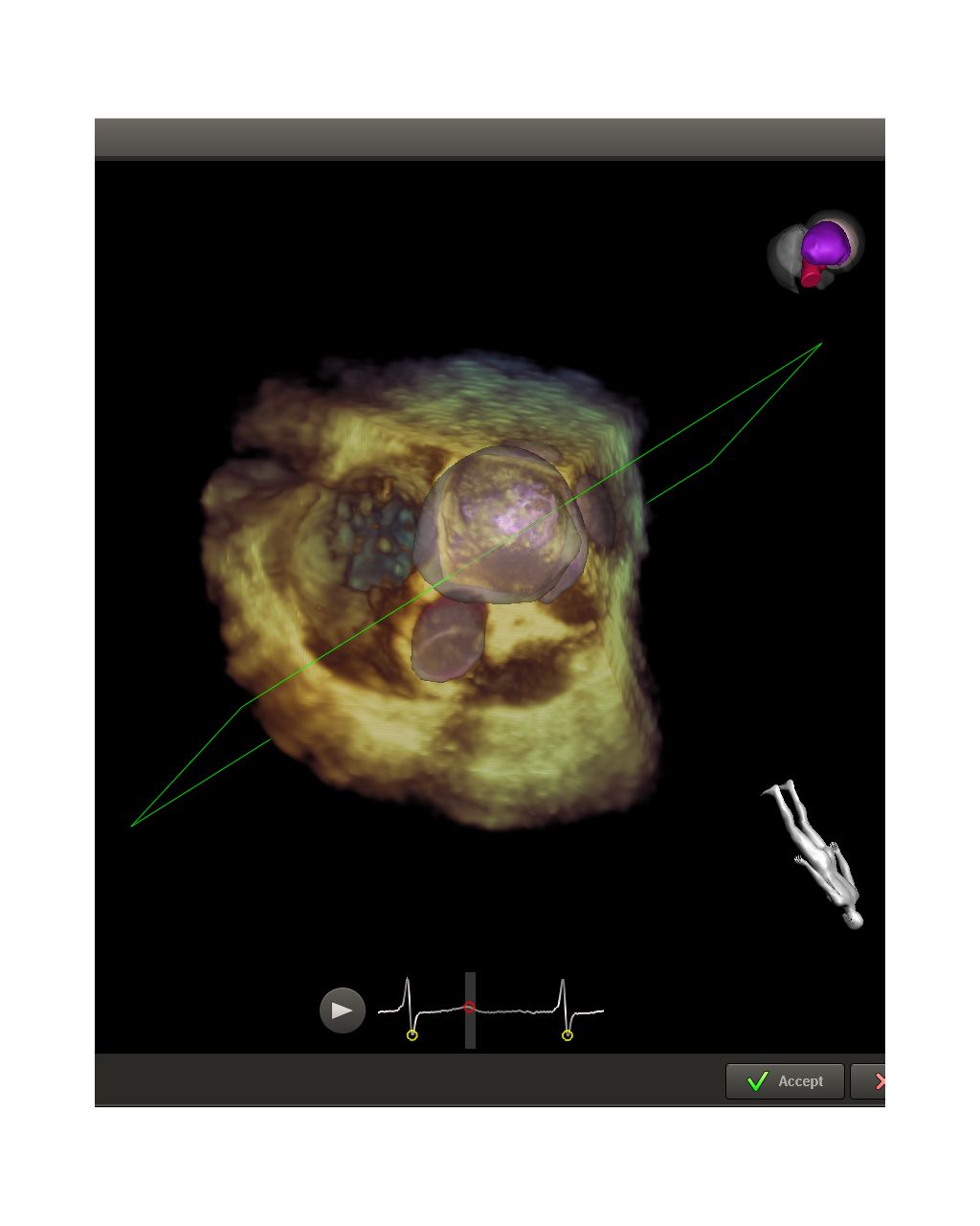 Example of EchoNavigator during Trans Septal Puncture phase