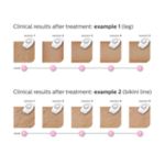 Easy, long term hair reduction