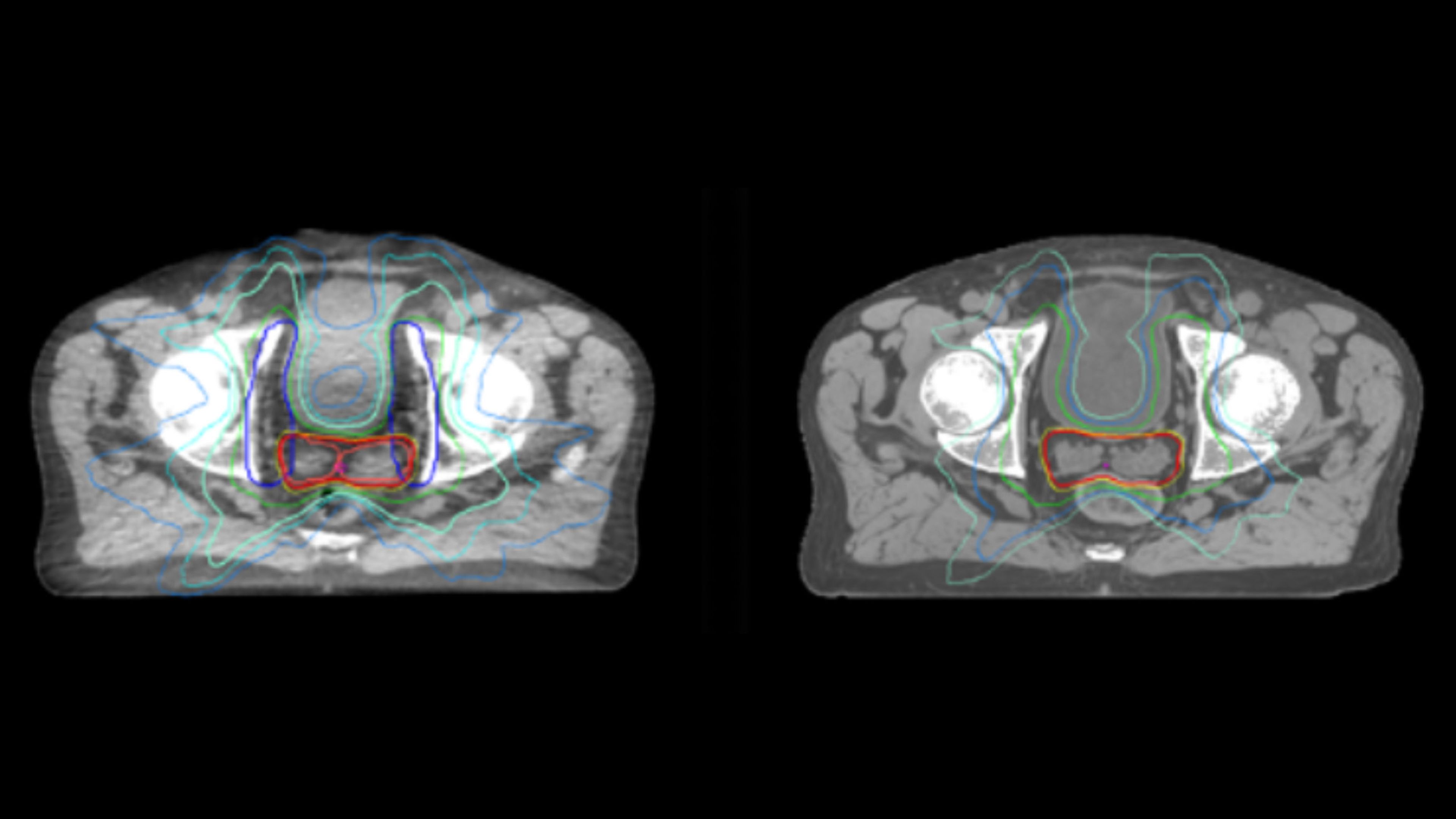 Dose plans overlaid on CBCT image dataset (left) and on MRCAT image dataset (right). 