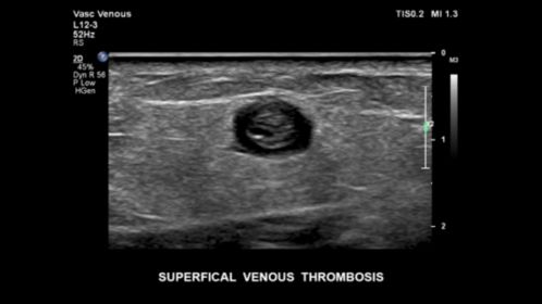 EPIQ ultrasound machine clinical image superficial venous thrombosis