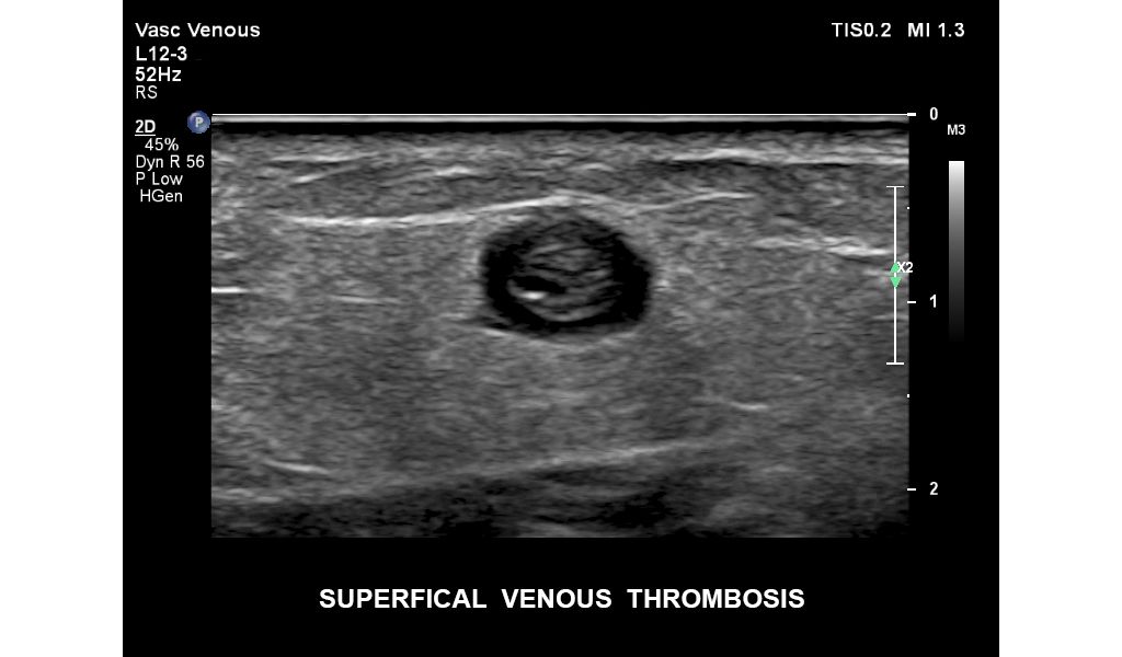 EPIQ ultrasound machine clinical image superficial venous thrombosis