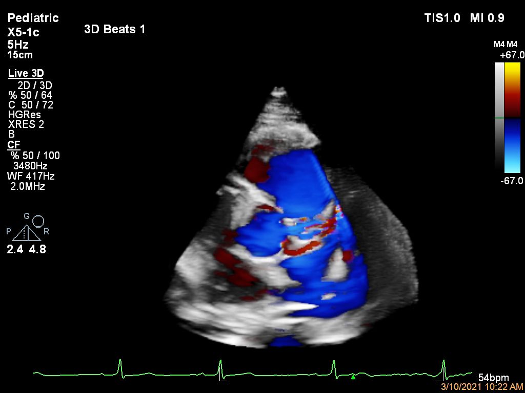 x5-1c Pediatric Coronary