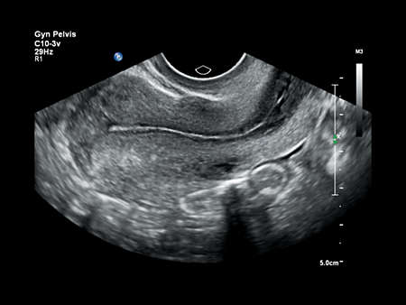 C10-3v Uterus Imaging
