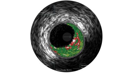 Real-time lesion assessment in the cath lab