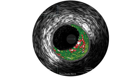 Real-time lesion assessment in the cath lab