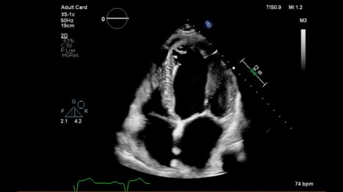 EPIQ CVx X5-1c 2D Apical 4 chamber heart