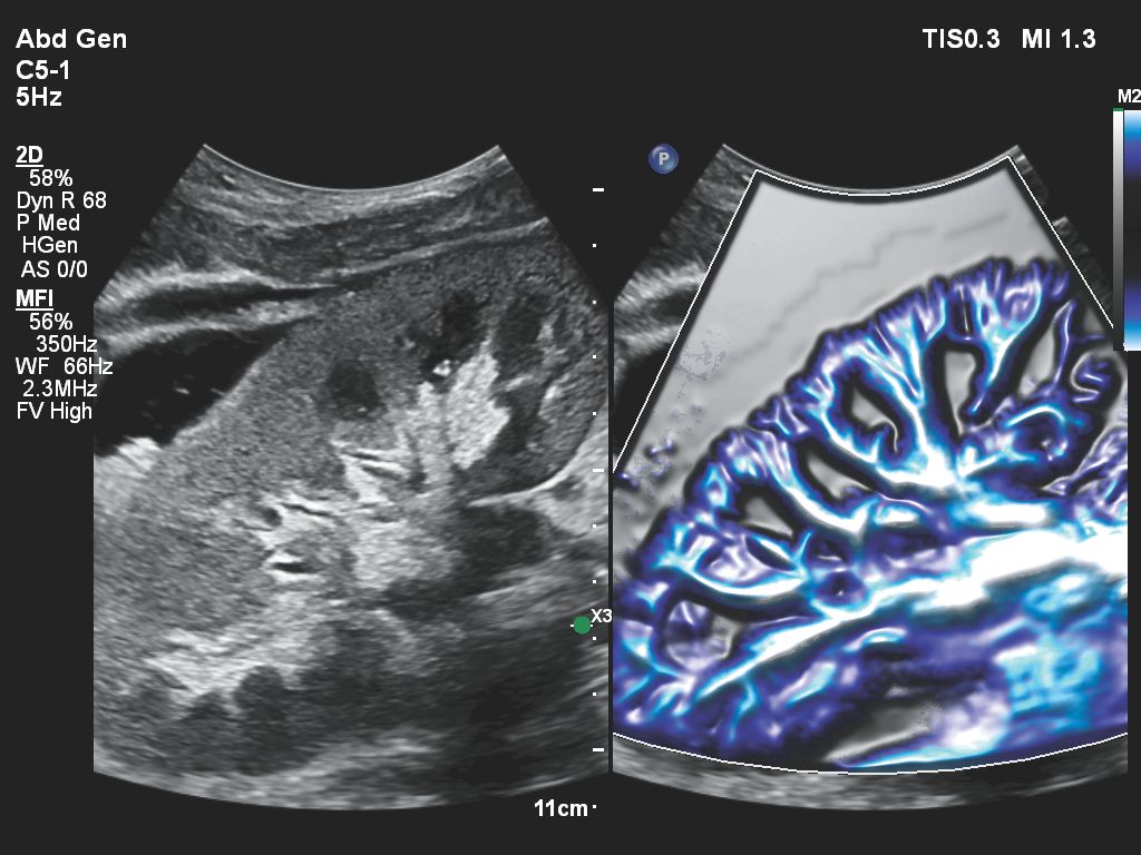 Renal transplant MFI with Flow Viewer using C5-1 transducer