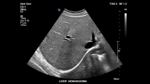 C5-1 Liver Hemangioma
