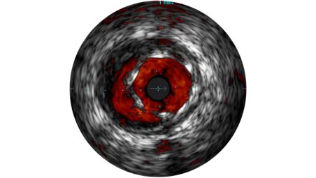 ChromaFlo resalta el flujo sanguíneo en color rojo para evaluar fácilmente la colocación de la endoprótesis vascular, el tamaño de la luz y más.