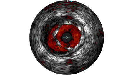 ChromaFlo met en évidence le débit sanguin en rouge pour faciliter l’évaluation de la pose du stent, de la taille de la lumière et plus encore.