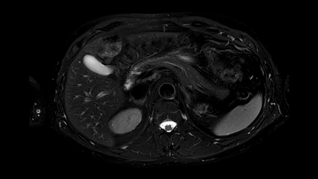 Axial Motion Free T2w Fat Sat
