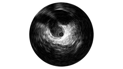 Grayscale enhances angiography by enabling a detailed view from inside the artery or vein