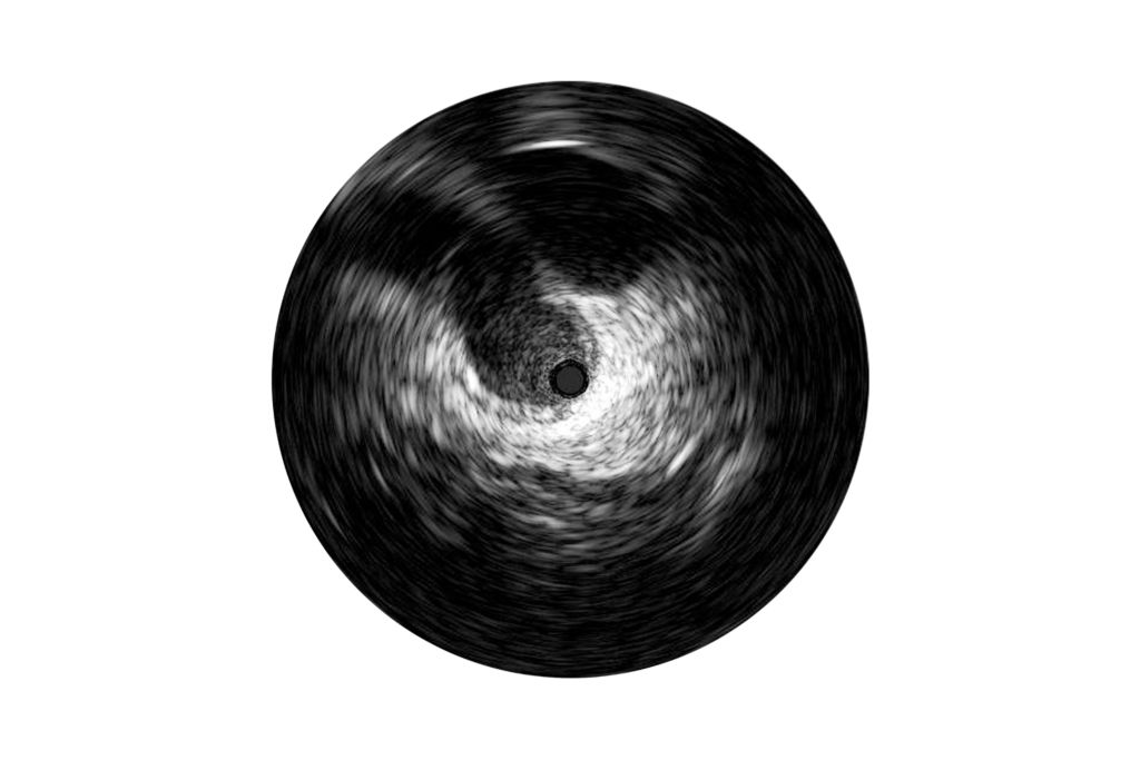Grayscale enhances angiography by enabling a detailed view from inside the artery or vein