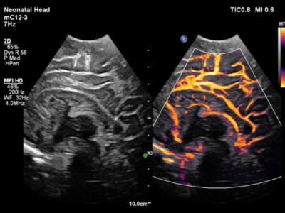 Ultrasound Web MFI