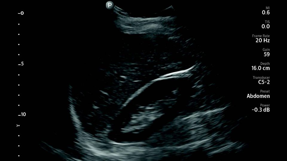 Abdominal ultrasound scan using Lumify