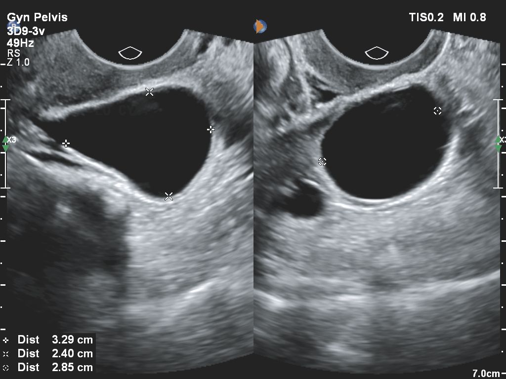 Affiniti 30 ultrasound clinical image gynecology