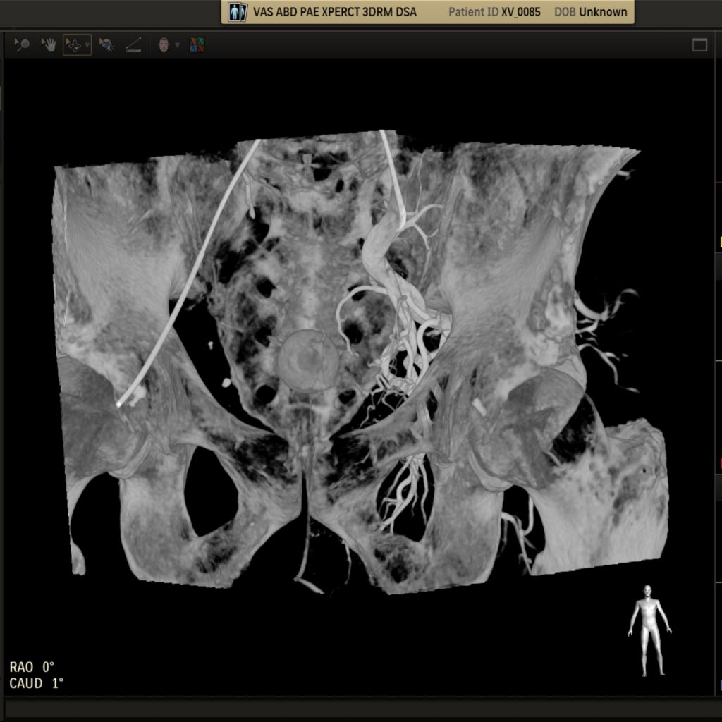 SmartCT PAE clinical image