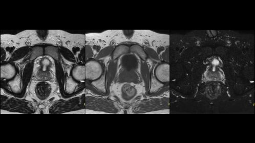 T2w / T1w / T2w SPAIR - Prostate