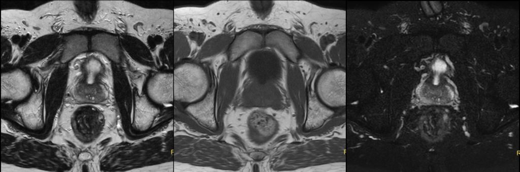 T2w / T1w / T2w SPAIR - Prostate