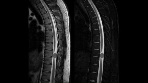 mDIXON XD TSE - T2w TSE In Phase (left), Water Only (right)