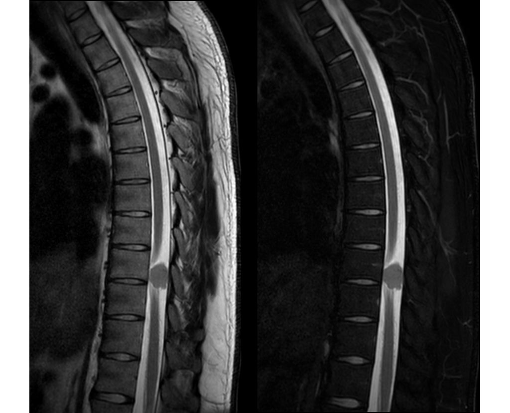 mDIXON XD TSE - T2w TSE In Phase (left), Water Only (right)