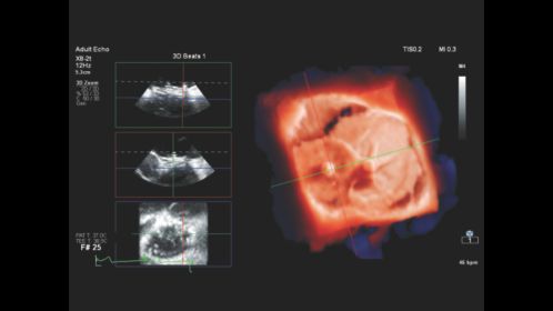 Échographie 3D du coeur