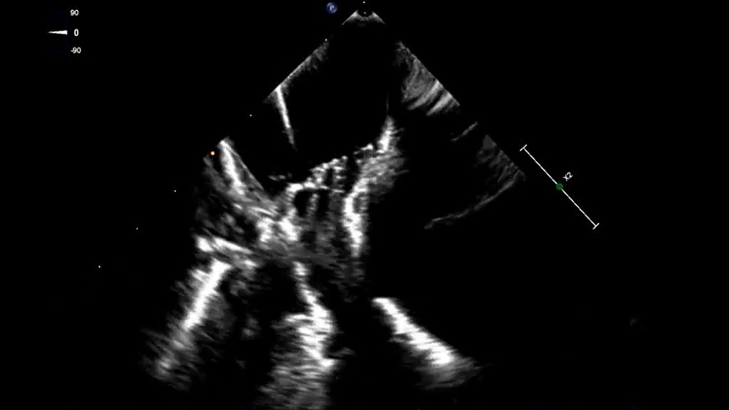 PFA Procedure VeriSight ICE Image Contact