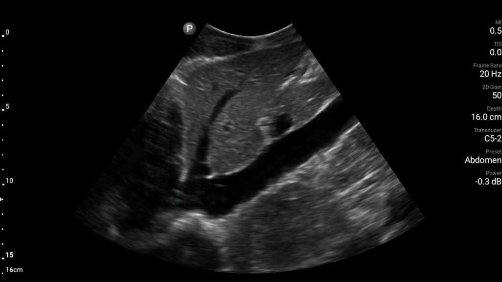 Longitudinal abdomen with IVC shown using C5-2 transducer.
