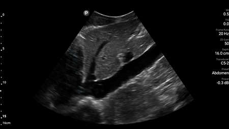 Longitudinal abdomen with IVC shown using C5-2 transducer.