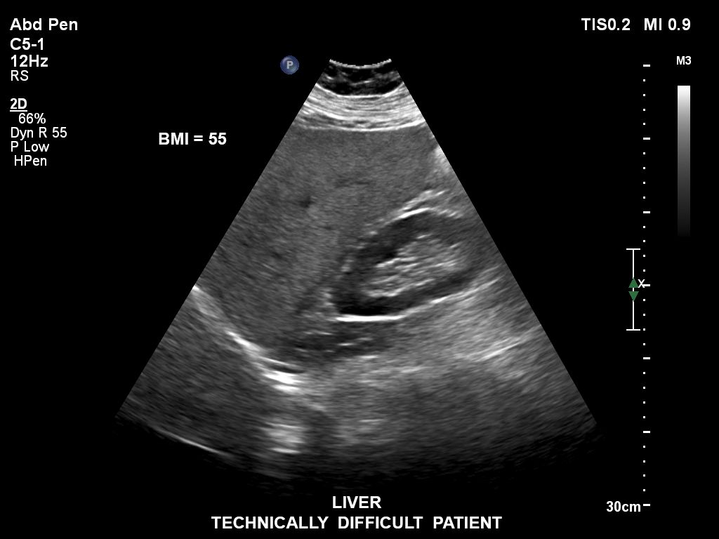 EPIQ ultrasound machine clinical image of a liver.  