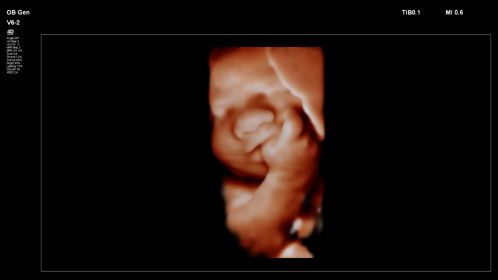 Fetal image with fingers in mouth shown with TrueVue on V6-2 transducer