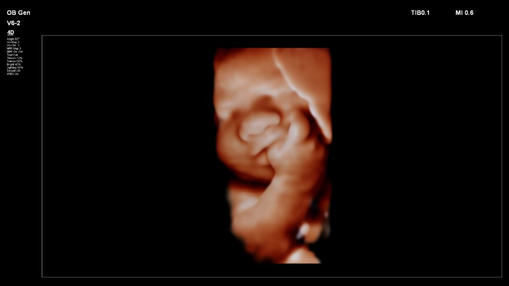 Fetal image with fingers in mouth shown with TrueVue on V6-2 transducer