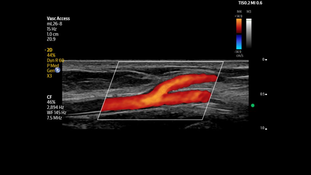 Longitudinal view of the radial artery shown using mL26-8 transducer.